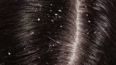 What is dandruff, How to Get rid of it